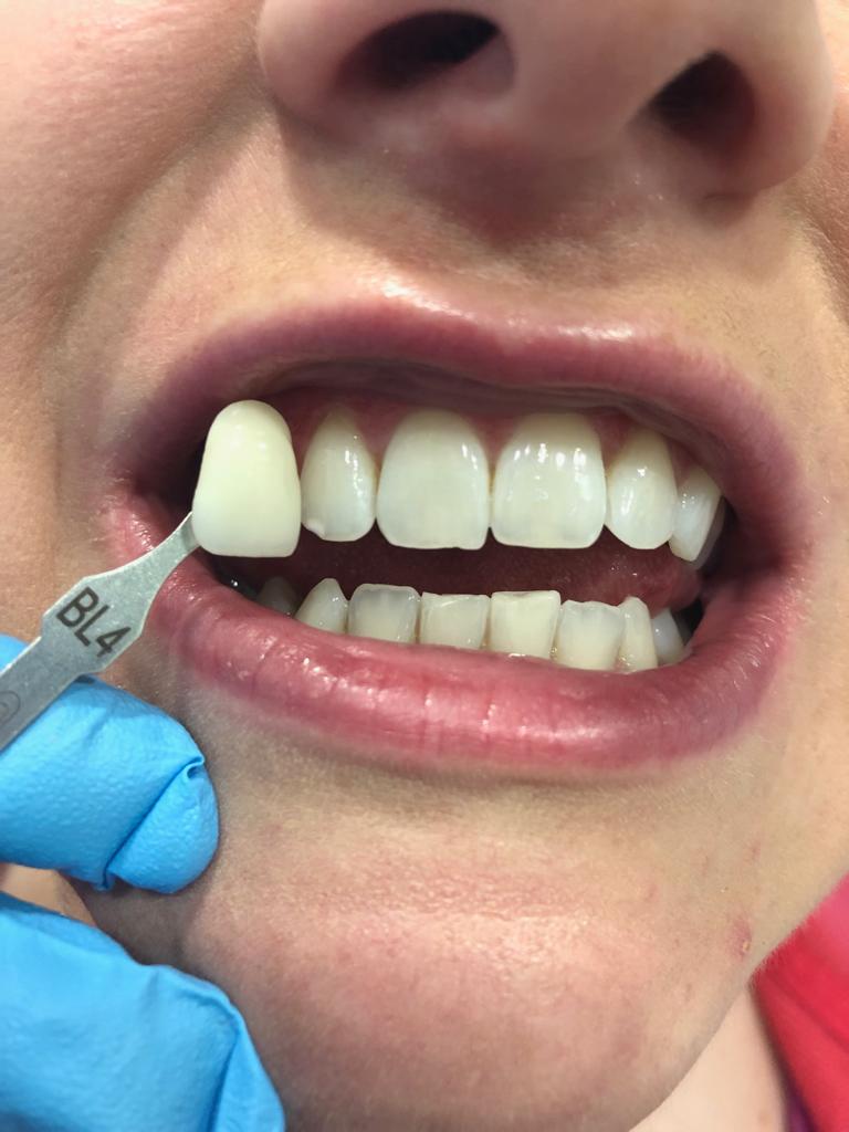 Teeth Whitening Dentists in Belfast Zoom Enlighten Whitening