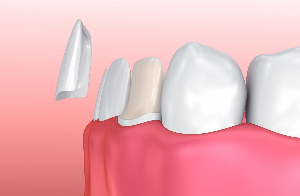 Porcelain Dental Veneers in Belfast Composite Veneers Belfast Dentists