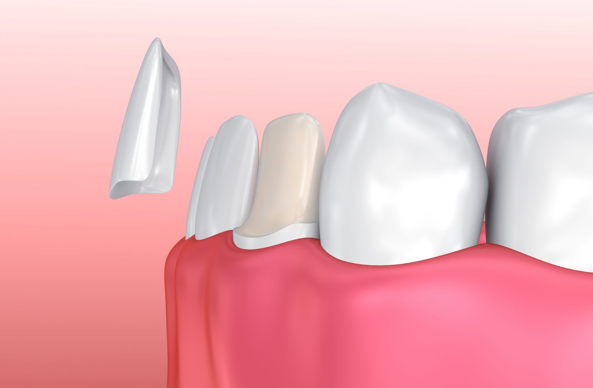 Porcelain Dental Veneers in Belfast Composite Veneers Belfast Dentists